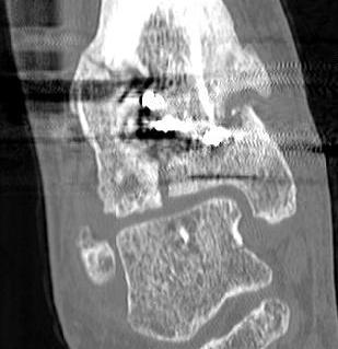 Distal Tibial Malunion CT